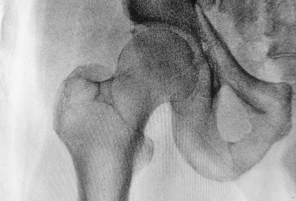 X-ray Hip Fracture